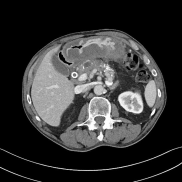 一文读懂急性胃痛 CT 检查表现_胃壁