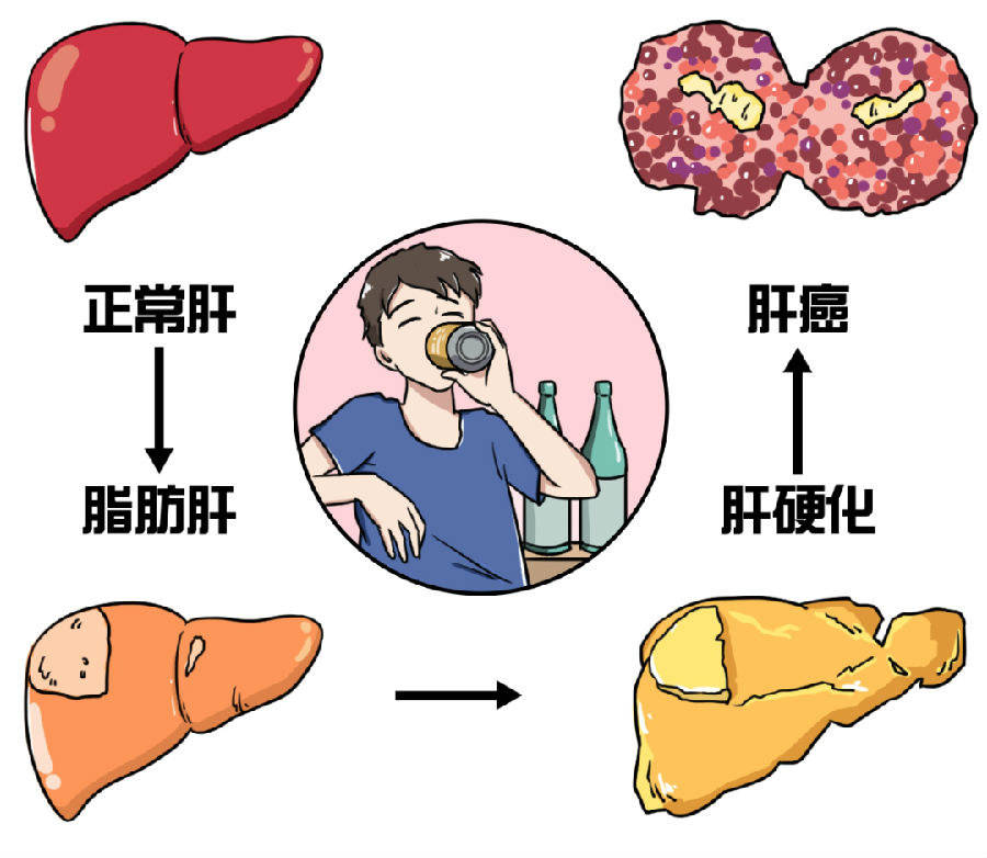 體檢出脂肪肝怎麼辦2種食物換著吃逐漸把脂肪肝吃掉