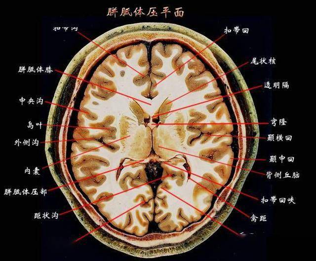 经胼胝体--透明隔间-穹隆间入路手术切除第三脑室肿瘤