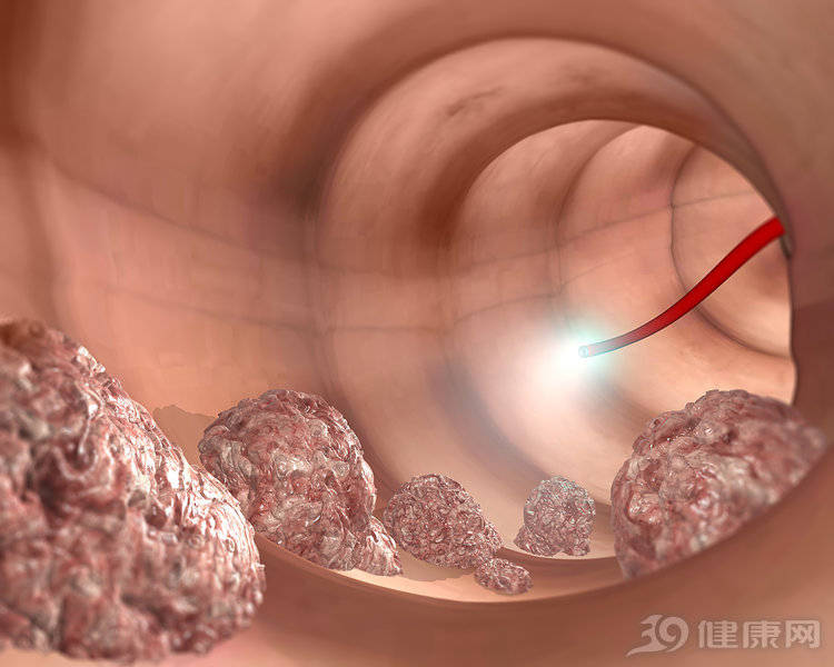原创出现这些症状可能是肠子长息肉了有人还后知后觉