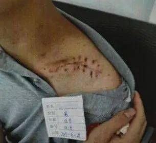 大姚一学生体育课受伤父母状告同学和学校