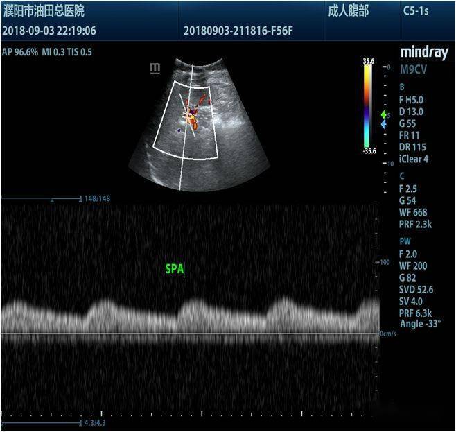 图 4 pw 示肠系膜下动脉( ima )正常频谱图 3 pw 示肠系膜上动脉( sma