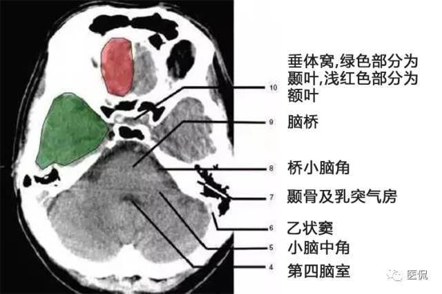 顱腦ct解剖口訣及彩色解剖圖