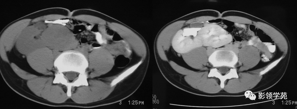 肾脏先天发育异常影像学诊断