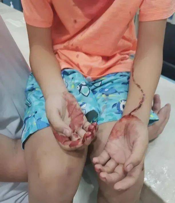 屡屡出事深圳一男孩玩耍时天降水泥块砸伤头部流血高空坠物如何处理