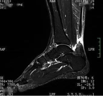 踝关节mri解剖及7种常见损伤类型