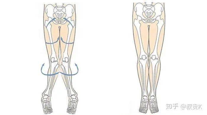 後,無法併攏大腿膝蓋和小腿那就是骨盆後傾,股骨及膝外旋導致的o型腿