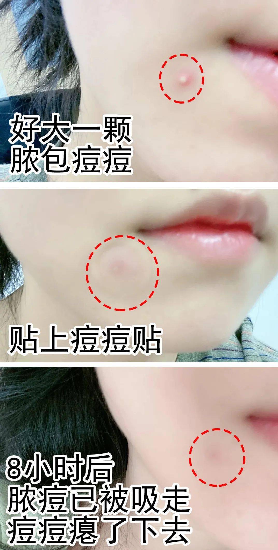 和外界环境充分隔离,  没有副作用,不刺激,只需轻轻一贴,  吸出大脓包