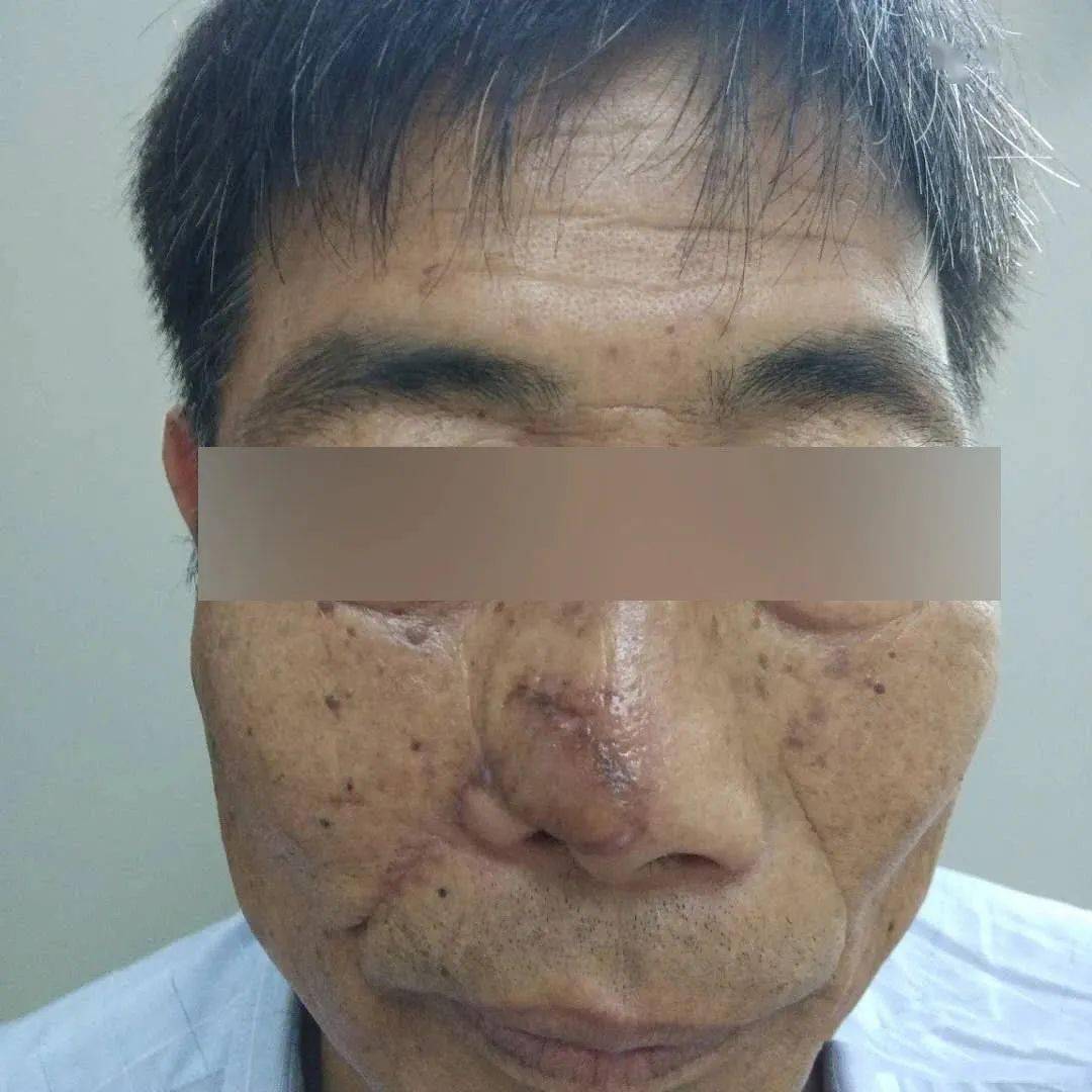 宜兴一男子鼻子上长了个疣自行治疗后没用一查竟是