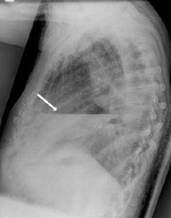 超实用识别气胸的几种方法书本上可没有讲过