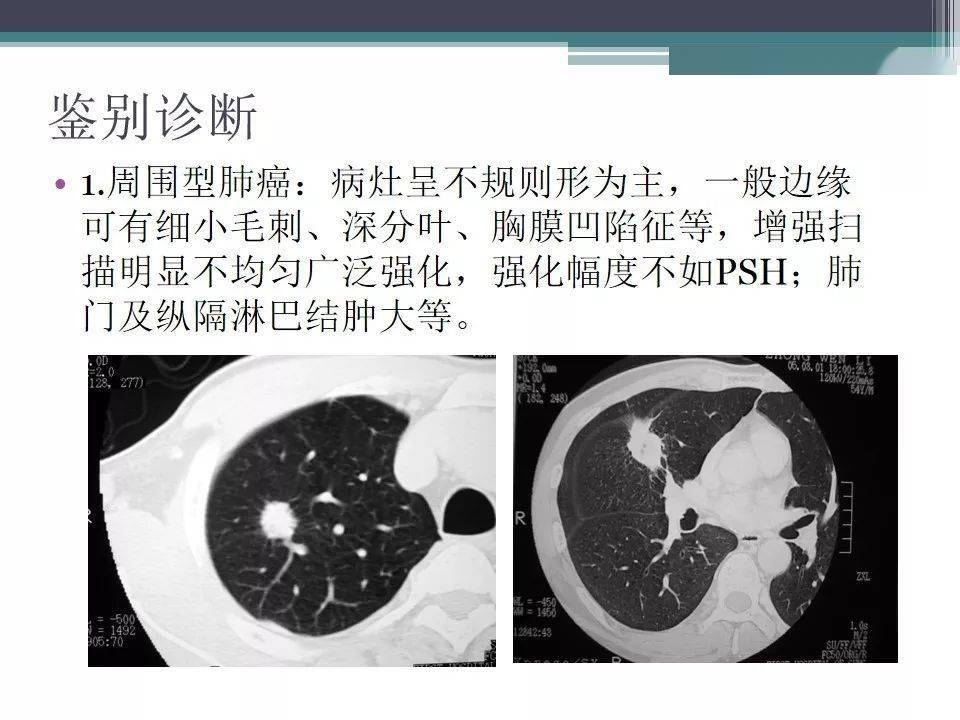 肺硬化性血管瘤psh影像表現