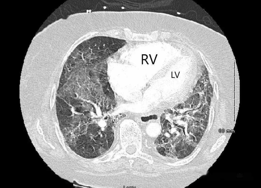 胸部ct增强扫描2,右心室(rv)明显扩大,几乎是左心室(lv)的两倍