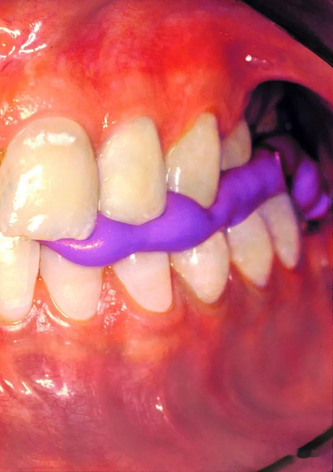 咬合记录硅橡胶和蜡片的区别