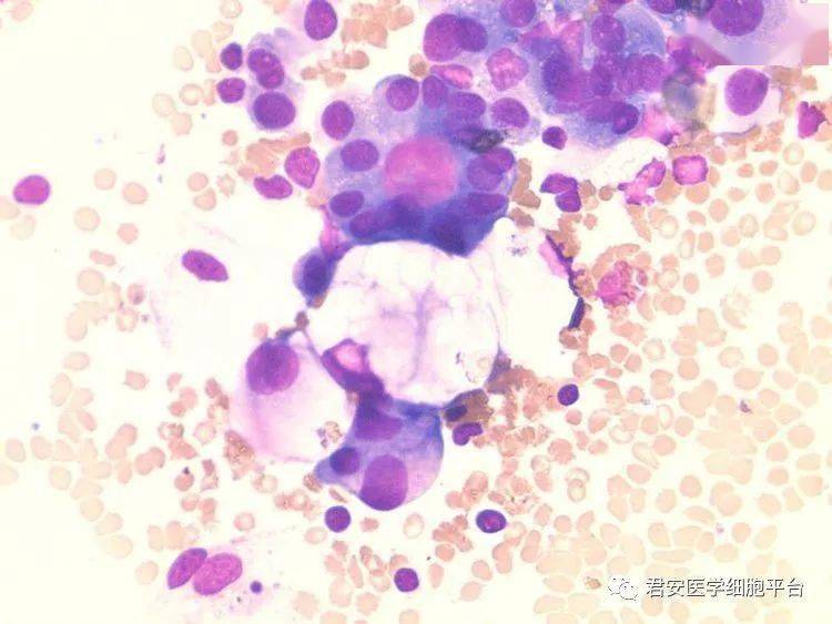 一例腺癌细胞胸腔转移病例分享