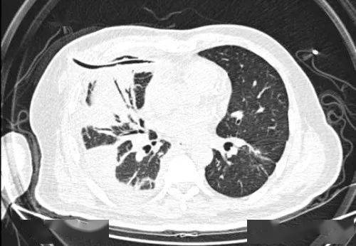 经过一个月的耐心治疗,急性脓气胸转变为慢性脓胸,胸膜纤维板形成
