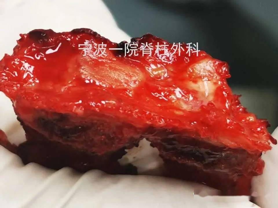 (术中取下的椎板,棘突和骨化的黄韧带)