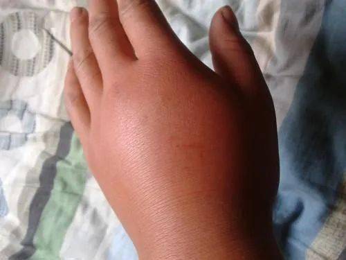 夏季小心这5种蚊虫千万别轻易拍死防蚊记牢这3点