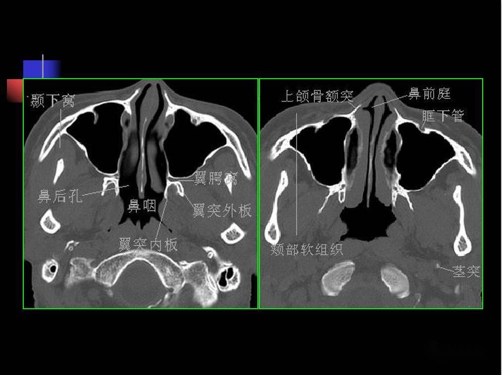 鼻窦轴位平扫ct解剖图图片