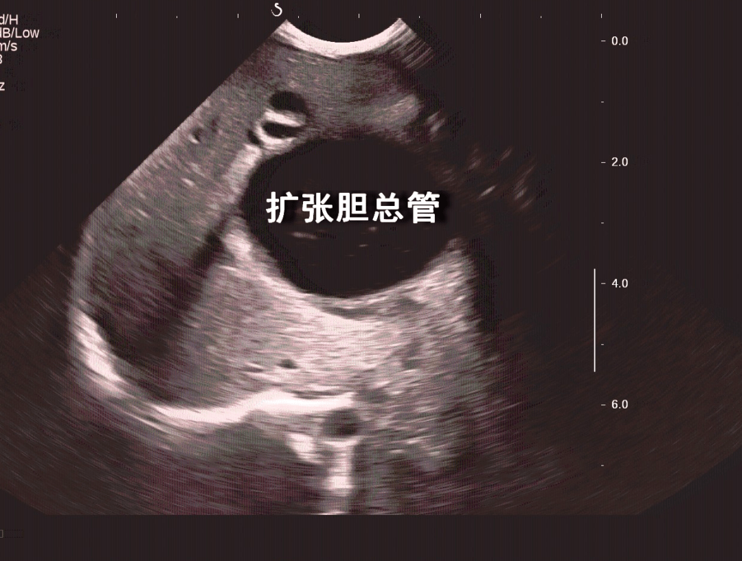 微创治疗先天性胆管扩张症,普外一科有办法!