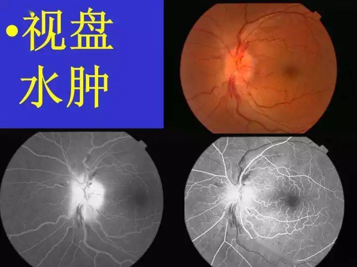 不同眼病的眼底血管荧光造影