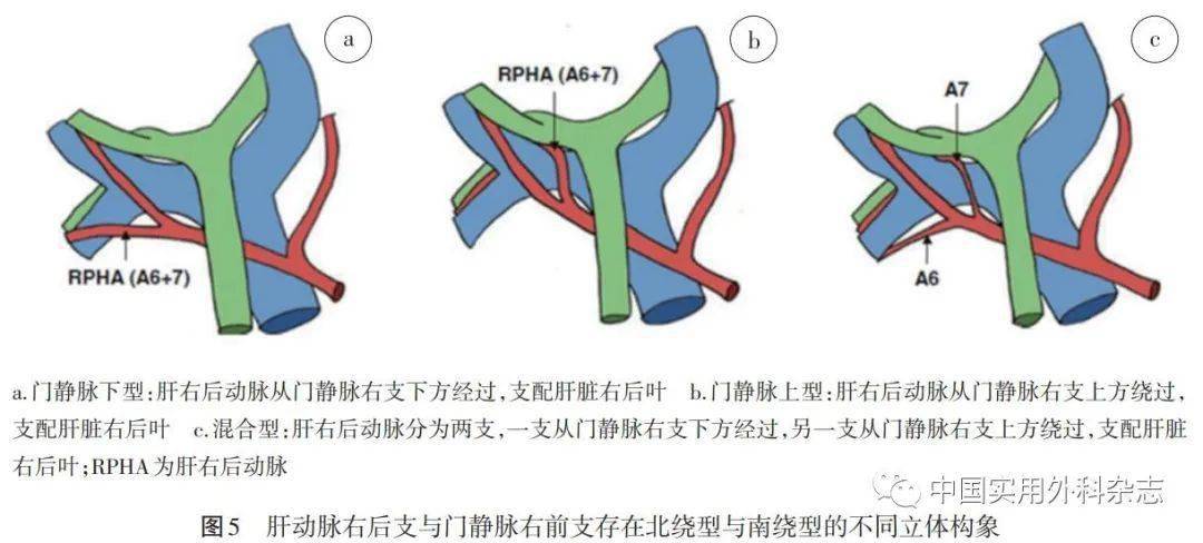 指南与共识围肝门区域外科技术临床应用路径中国专家共识2020版