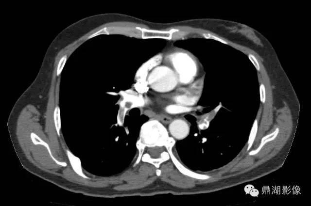 一些特别要注意的心血管ct影像征象