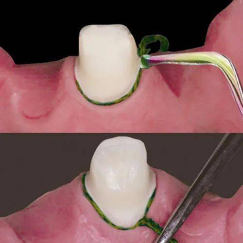 2,选用与龈沟宽度一致的排龈线,将排龈线起始断放置于预备基牙的近中