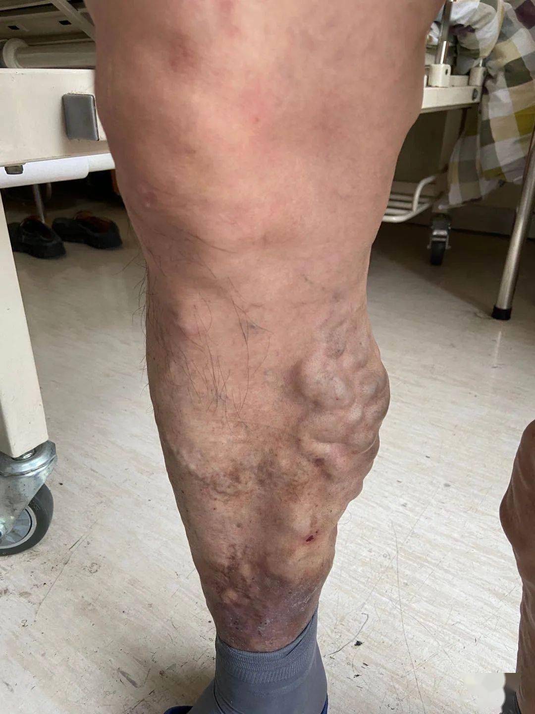 男子腿上多处长"蚯蚓"!几十年没穿过短裤