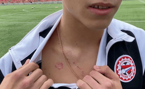 被闪电击中的俄罗斯球员已痊愈,医生:他太幸运了