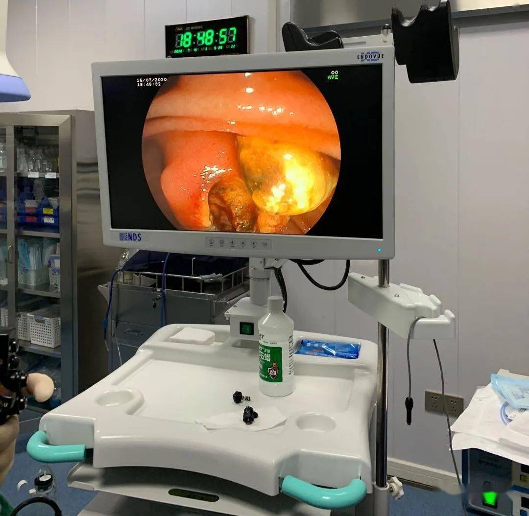 投资数百万元高安人民医院成功开展ercp新技术