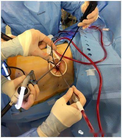 评述为什么要开展单孔vats肺叶切除术