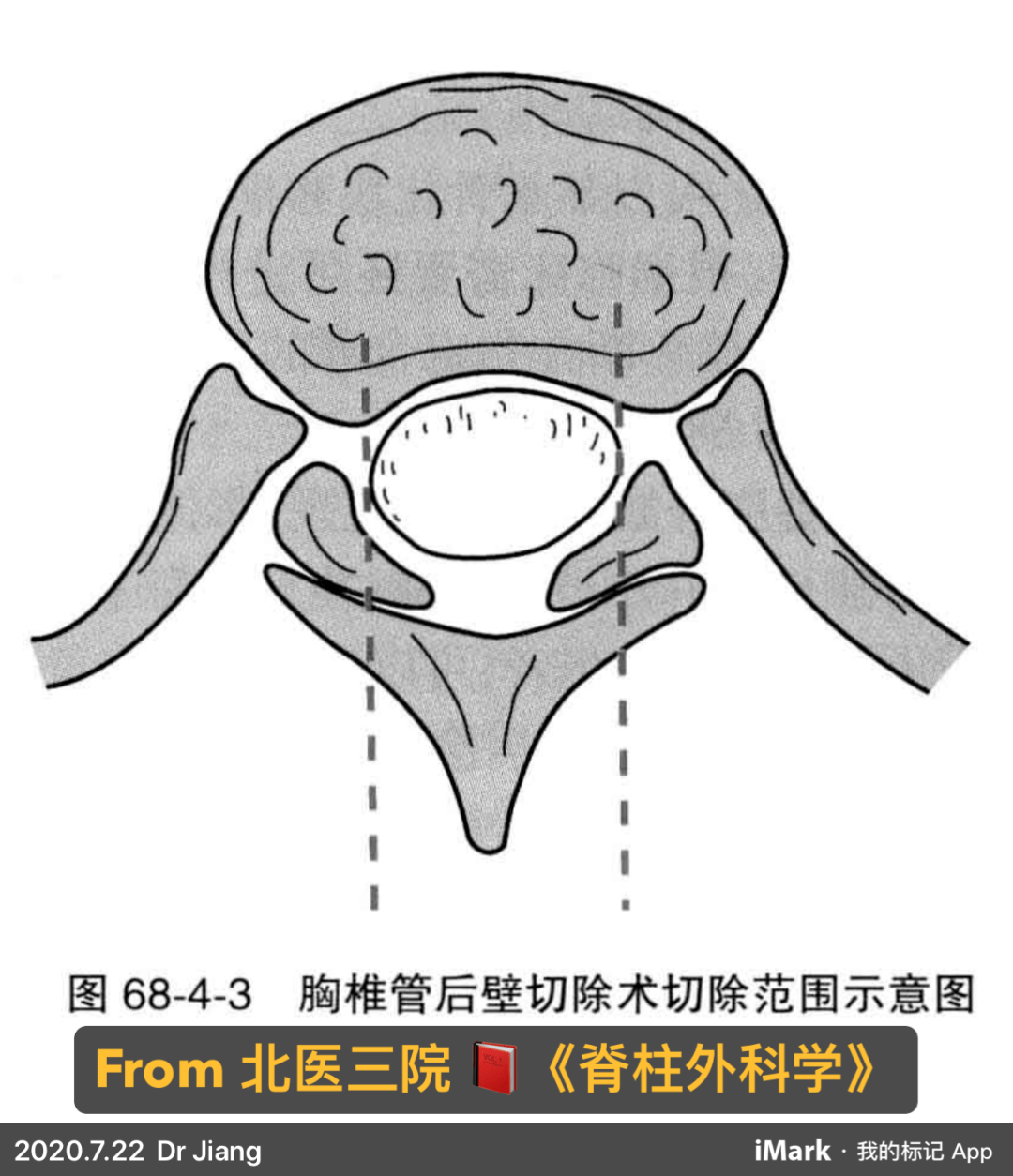 【伴你康復】雙腿沒勁困坐輪椅,胸椎管黃韌帶骨化症