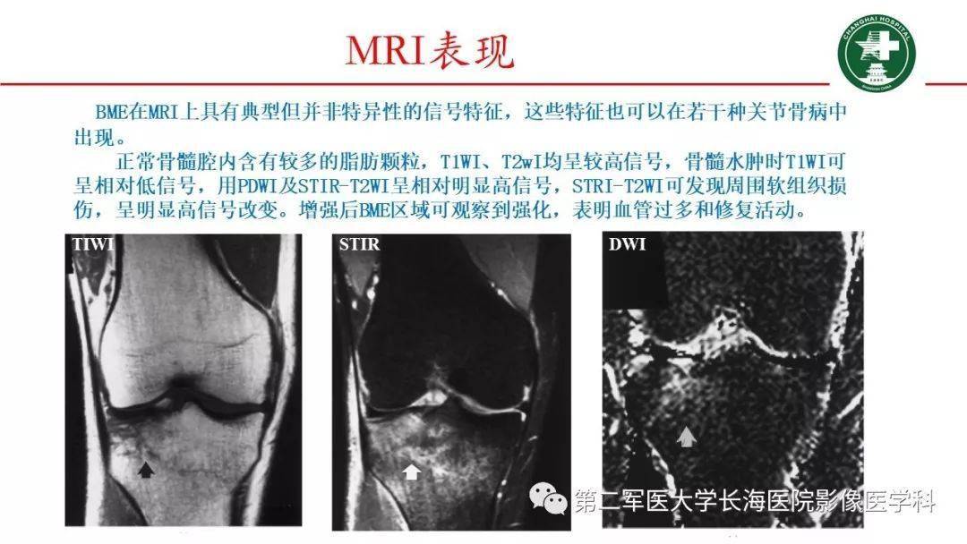 膝關節骨髓水腫的mri影像表現