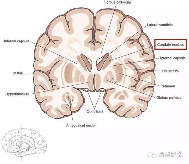 此外,與錐體外系功能有關丘腦底核,黑質和紅核,也可視為基底節的組成