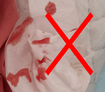 若是分泌物,外观上黏黏的,滴在纸巾上过一会儿会呈结痂状态.