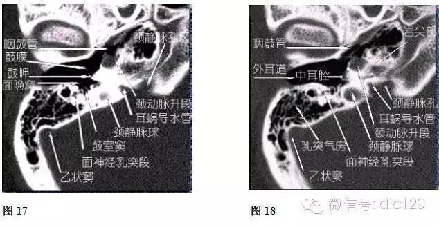 内耳ct解剖结构图图片