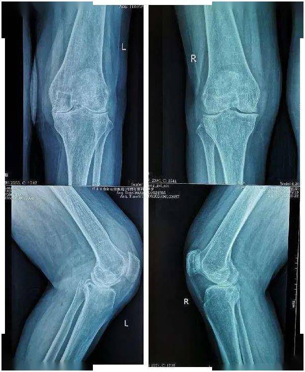 膝关节片子怎么看图片