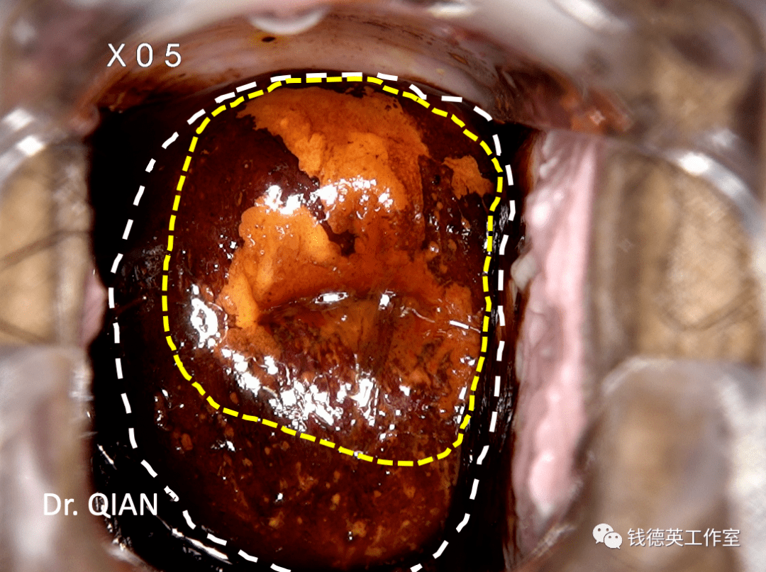钱医生出诊记事烧脑的宫颈锥切术