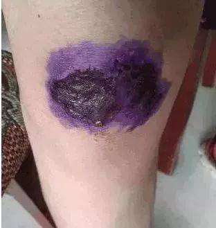 皮肤擦伤破皮到底该涂哪个?