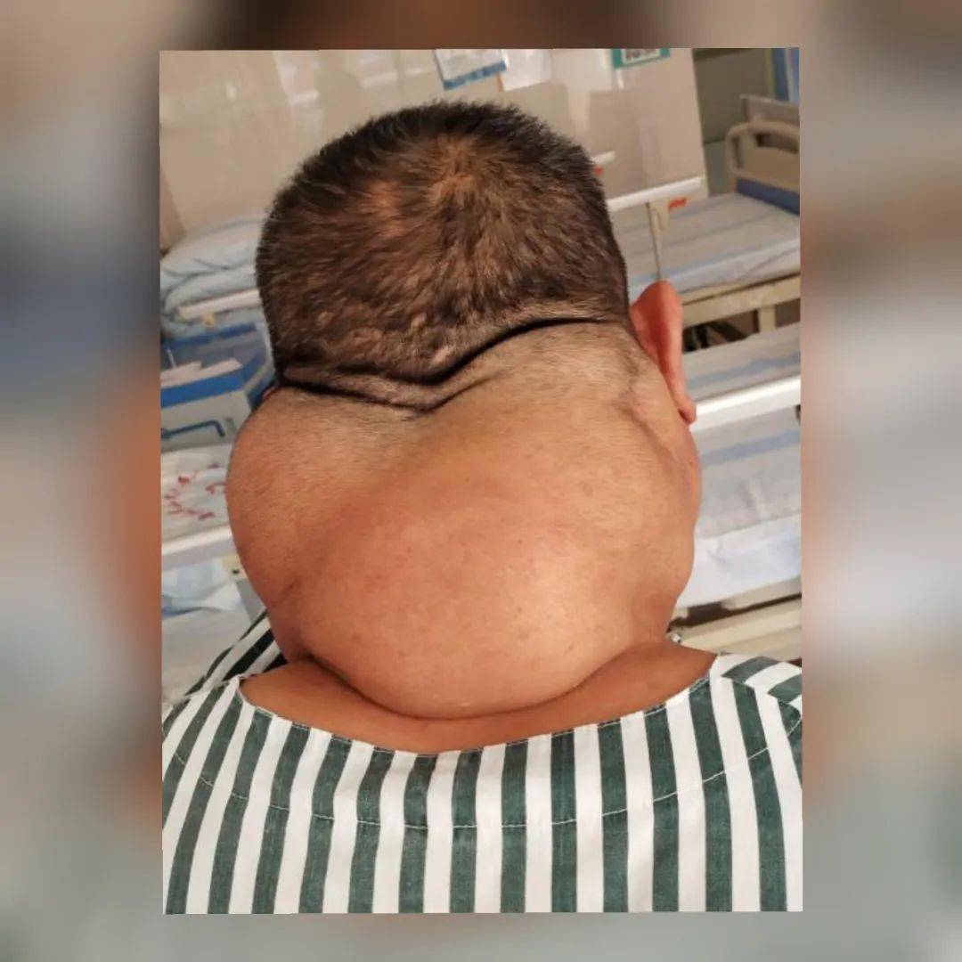 每天喝酒1斤半,男子颈部一次取出2斤重._大爷