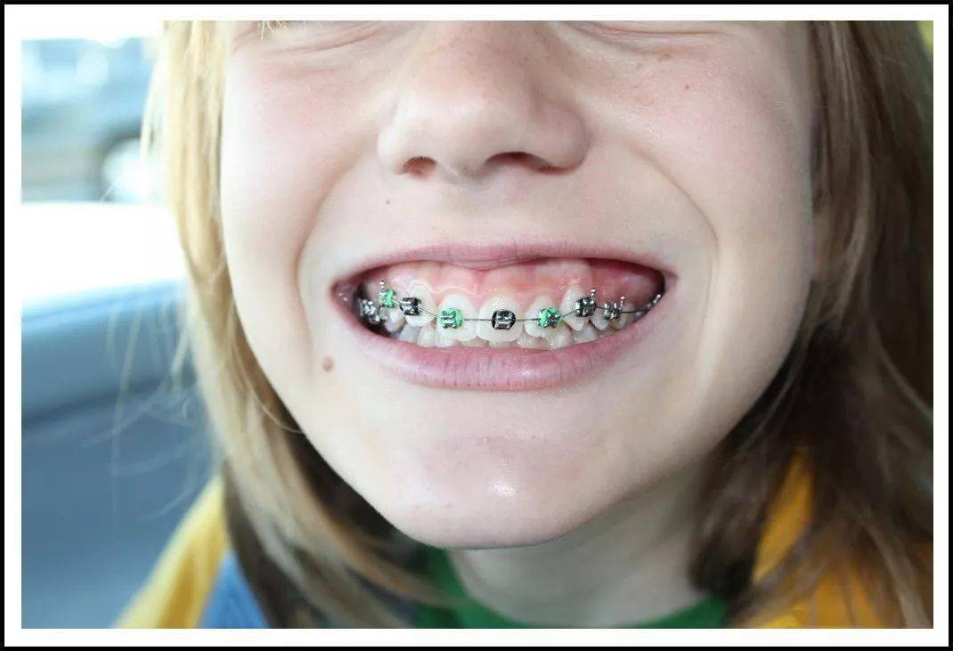 儿童牙齿矫正器 箍牙图片