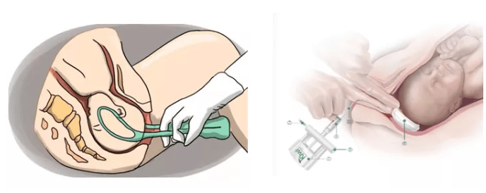 助产(operativevaginal birth)是指在第二产程使用产钳或胎头吸引器