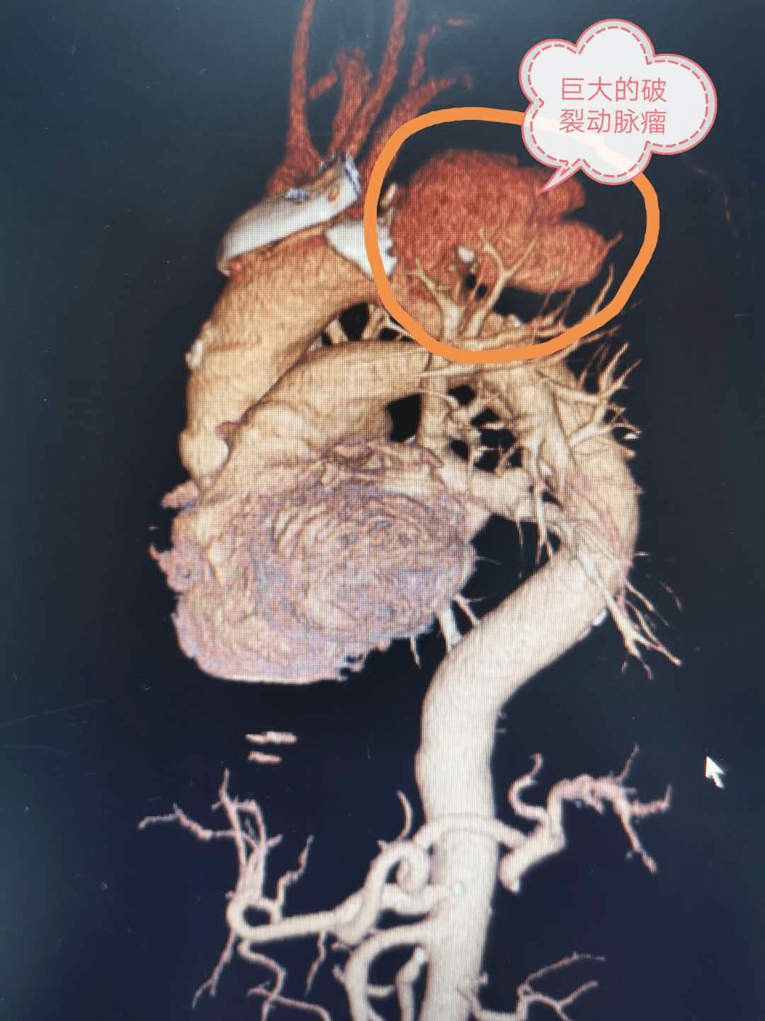 主动脉窦瘤破裂图片图片
