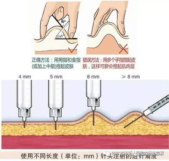 戈那瑞林注射位置图片