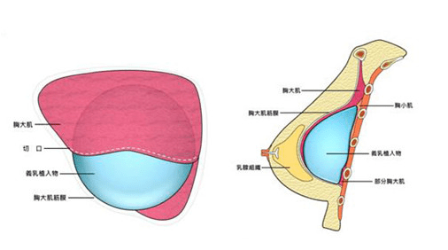 雖然假體大小由自己選擇,但 乳房皮膚彈 性和 皮下脂肪厚度也決定了可