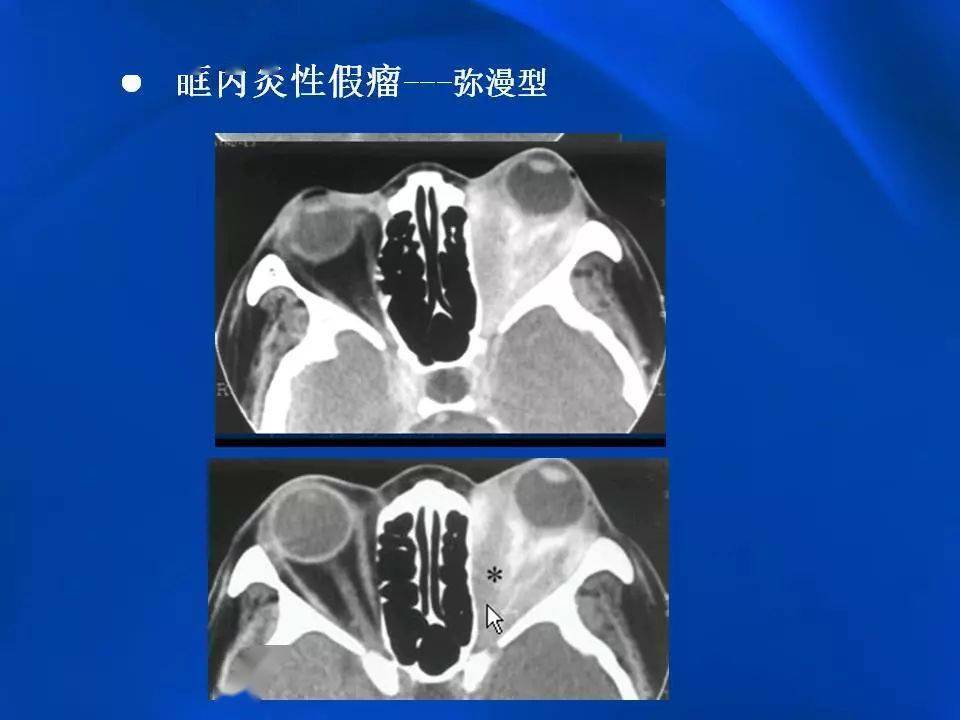 眶内炎性假瘤影像学表现