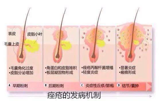 想搞定痤瘡這四種分型必須要清楚