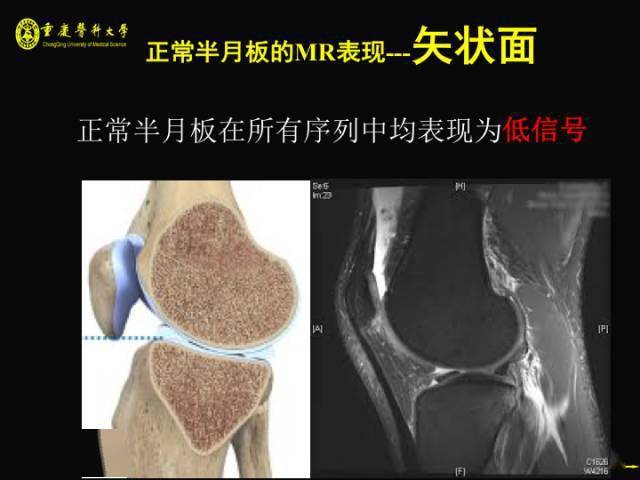 半月板撕裂的 mri 表現又是怎麼樣的?