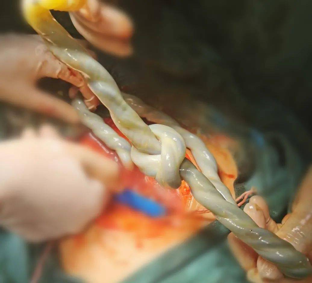 太惊险脐带打了两个结差点没了