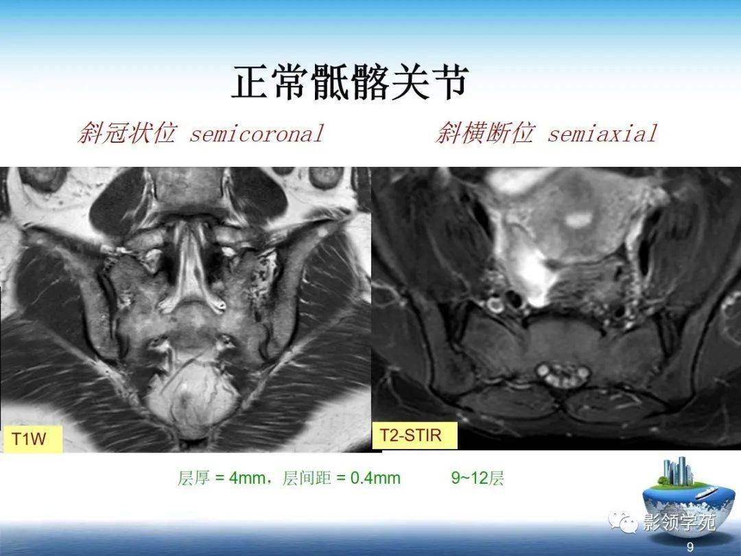 spa骶髂关节炎的影像学诊断与鉴别